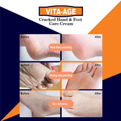 VITA AGE Cracked Hand & Foot Care Cream (30ml)